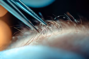 androgenic alopecia, ET-02