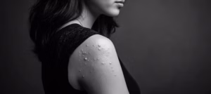 Bimekizumab, hidradenitis suppurativa
