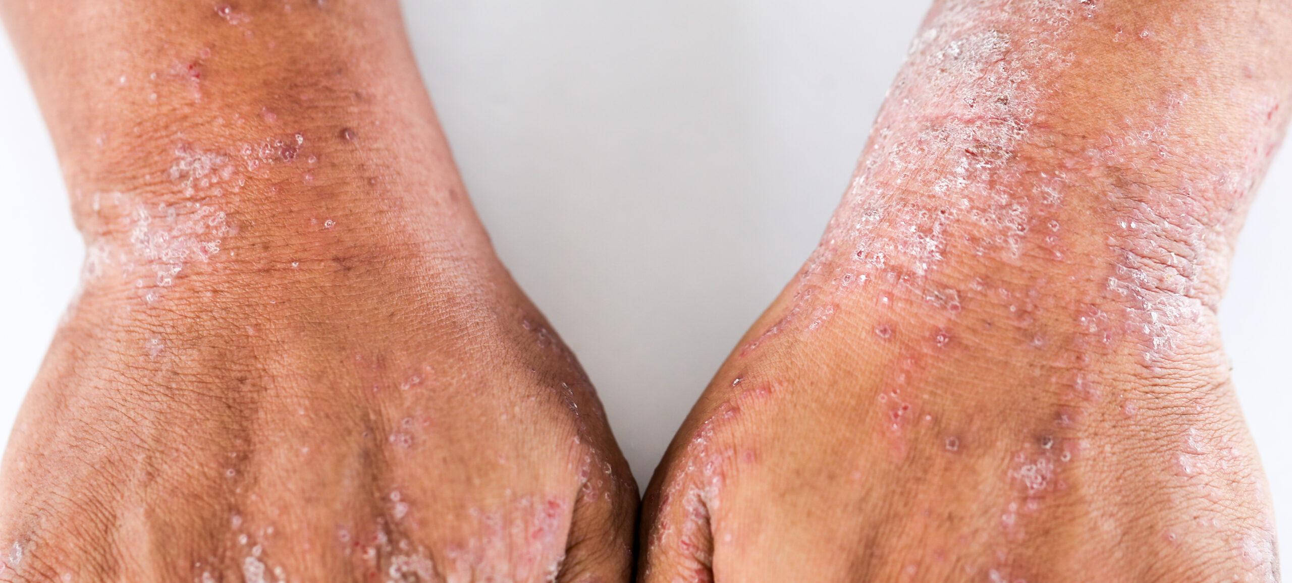 atopic dermatitis