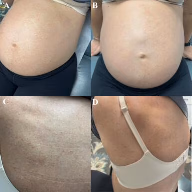 Figure 1: Clinical presentation of pregnancy-associated unilateral nevoid telangiectasia